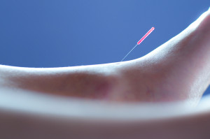 acupuncture
